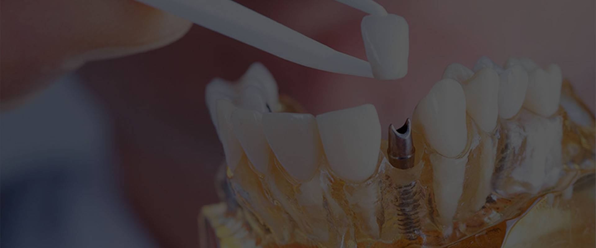 Implantes Dentários Dra Patricia